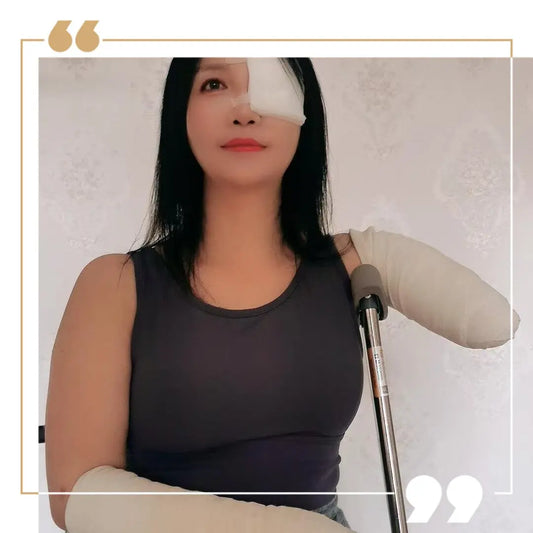 Lanzi OOE Amputee Girl - Injured limbs and eyes AmputeeClub