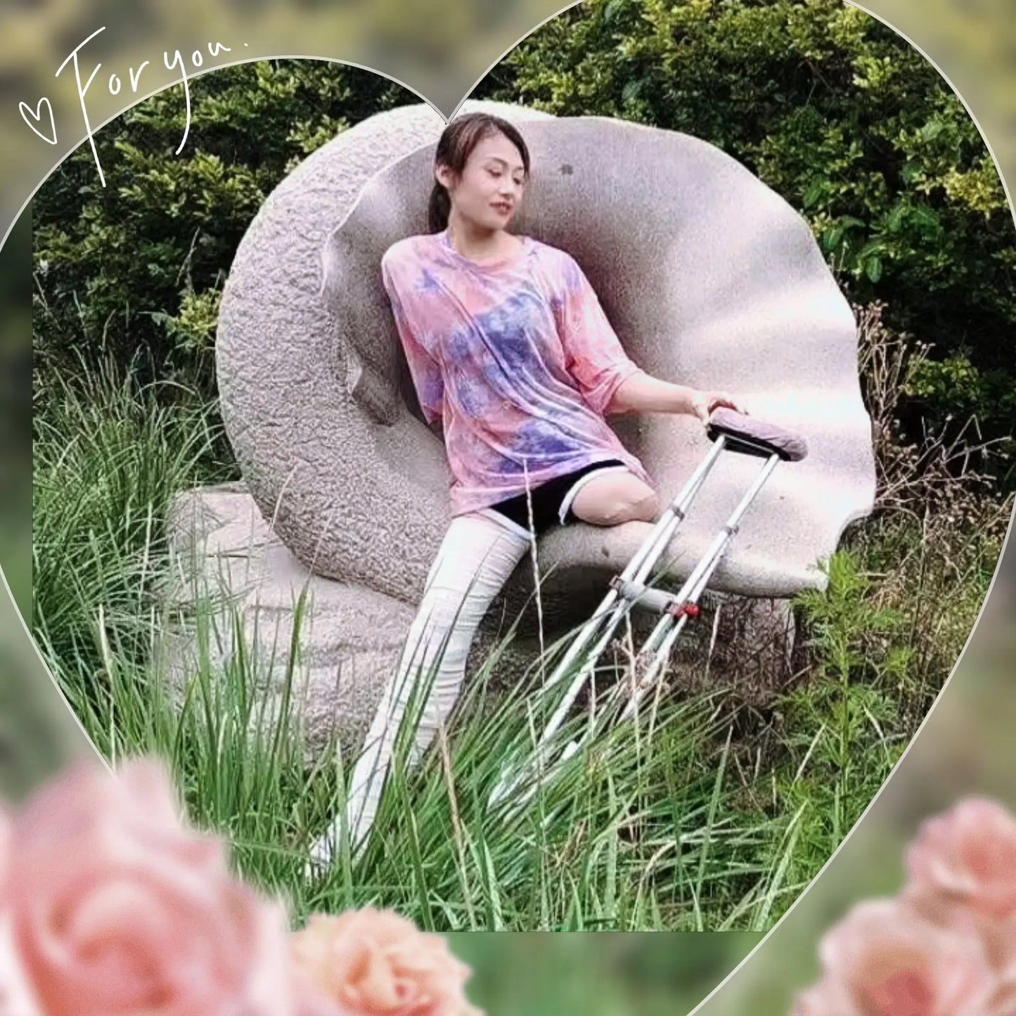 Ayla: Sak Amputee Girl leg cast AmputeeClub