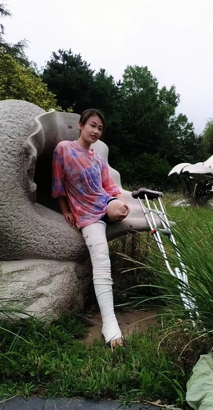 Ayla: Sak Amputee Girl leg cast AmputeeClub