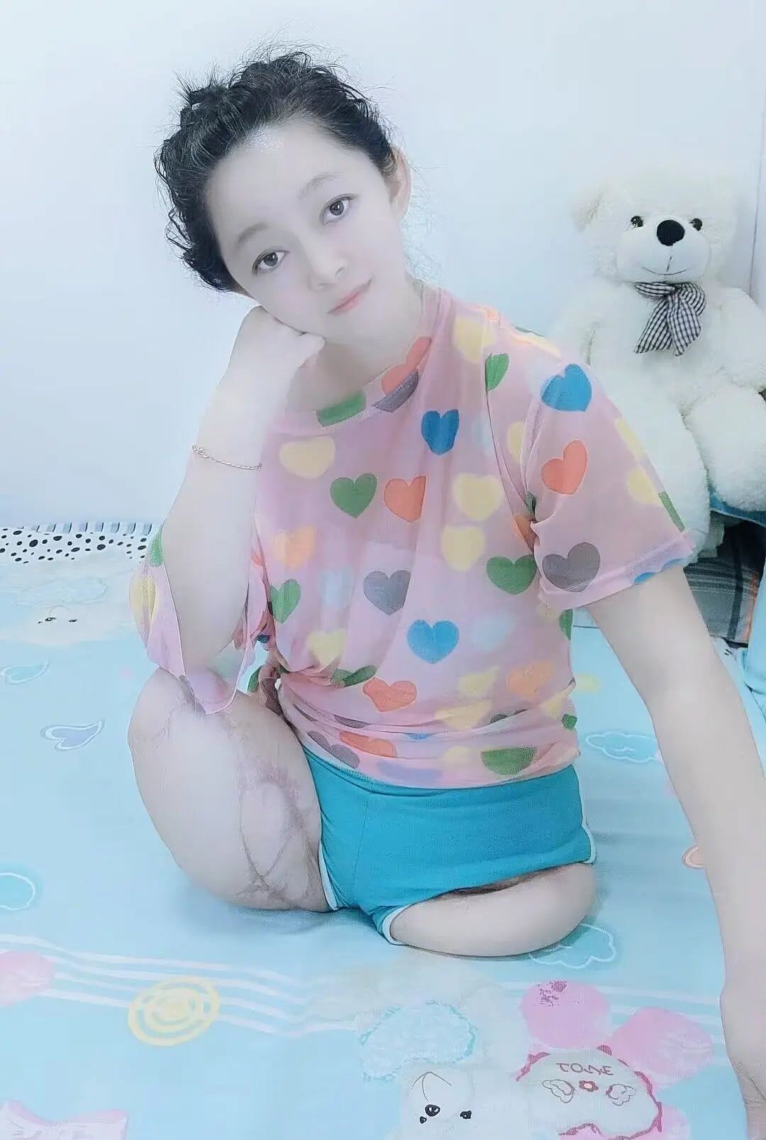 Sugar: Dak(Ak+Hd) Amputee Girl wakes up AmputeeClub