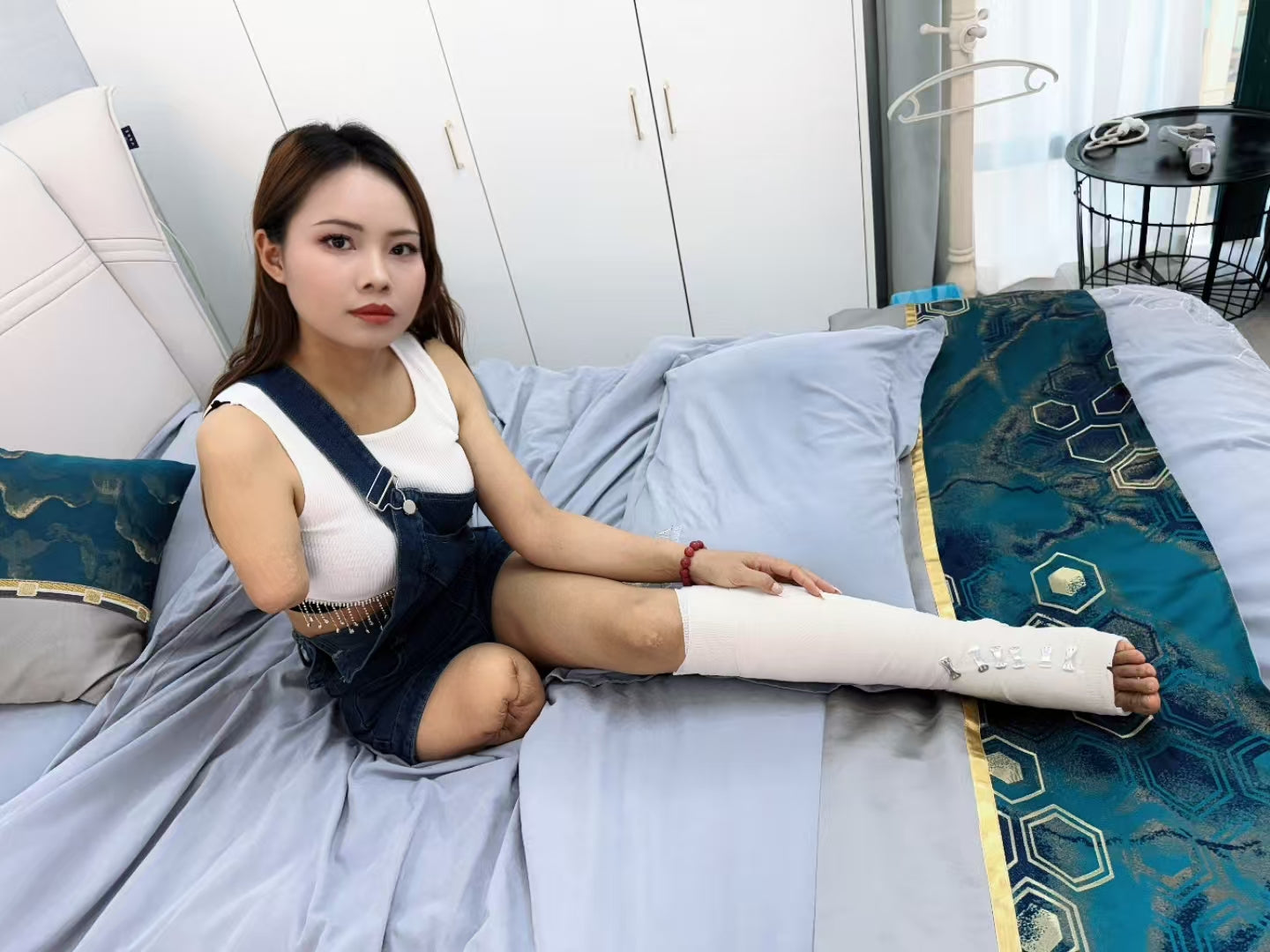 Abby: Ooe Amputee Girl - The Only Leg Cast
