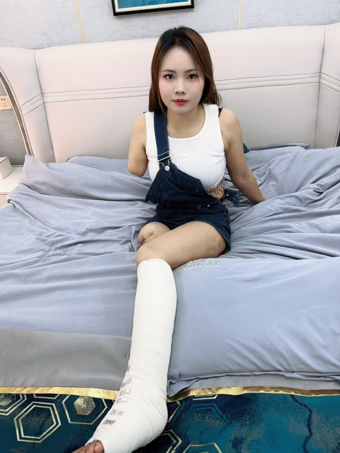 Abby: Ooe Amputee Girl - The Only Leg Cast