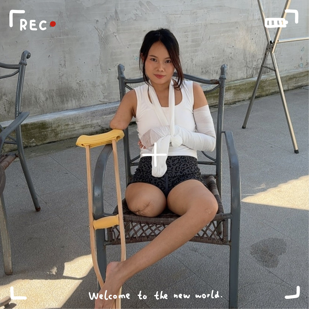 Abby Ooe, the Amputee Girl – Bandaged Amputated Limb