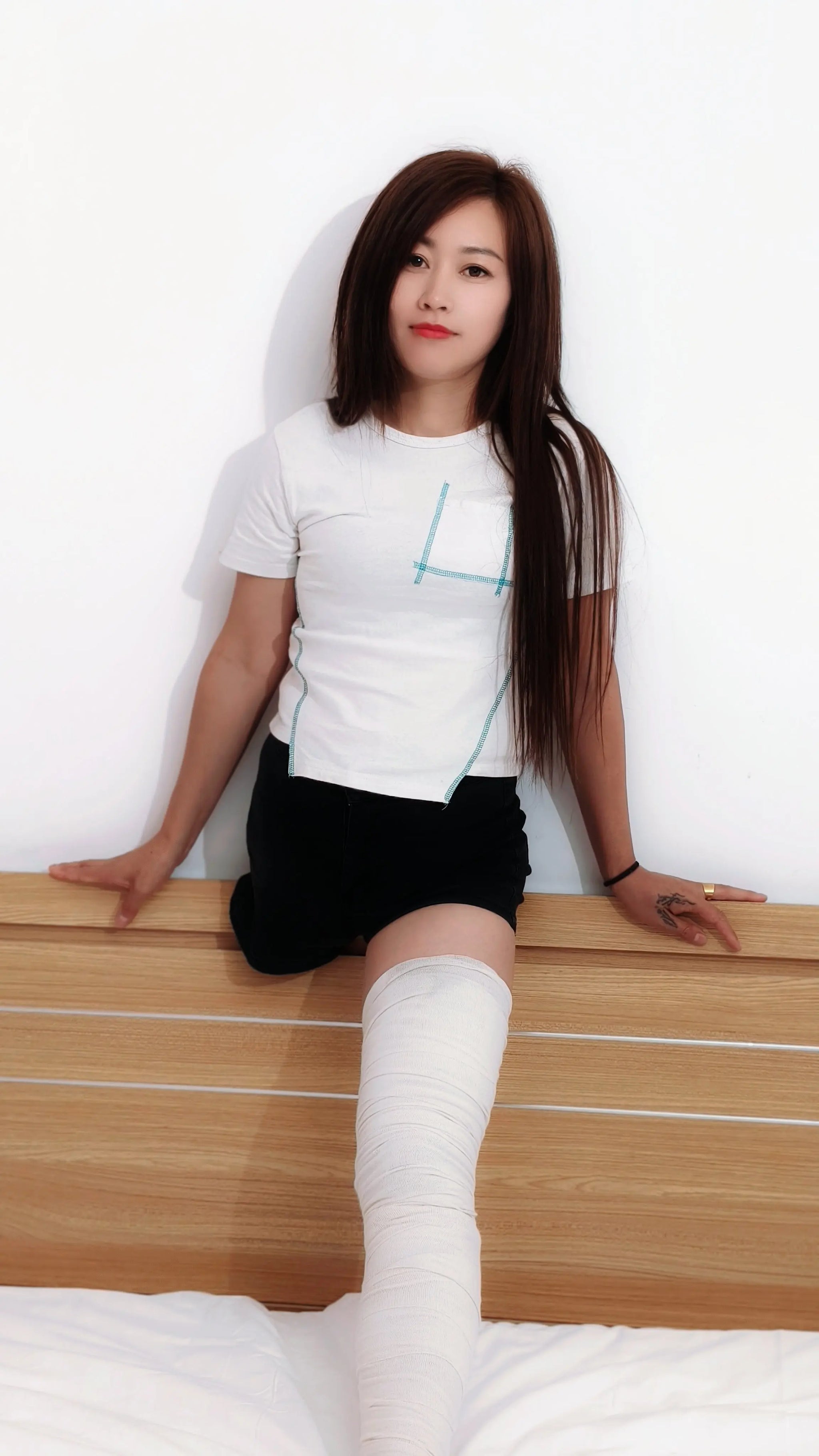 Emma:RHD Amputee girl legcast AmputeeClub